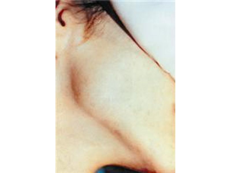 Hair Removal Hair Removal