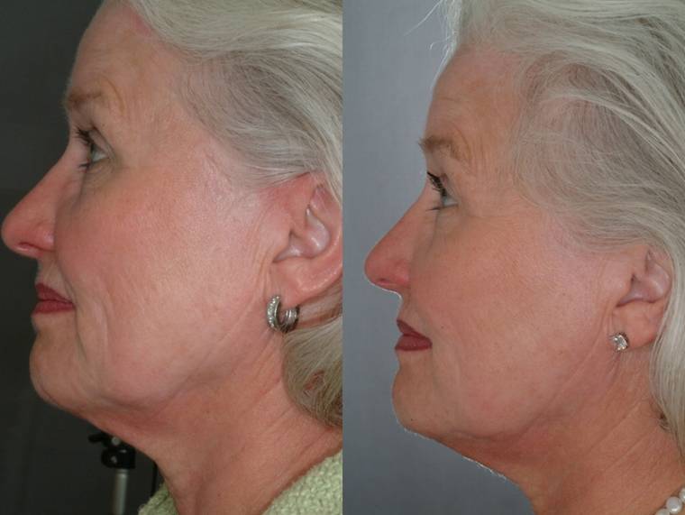 Wrinkles The Outcome Is All That Counts Laser Health Body Slim